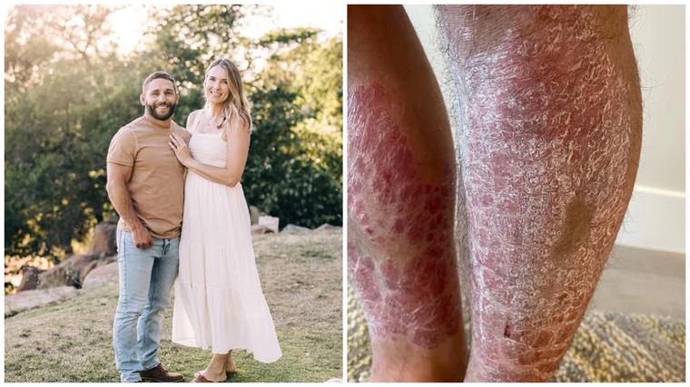 Keď nezabrali lieky na psoriázu, vybral si extrémne riešenie. Funguje, ale lekárom stoja vlasy dupkom